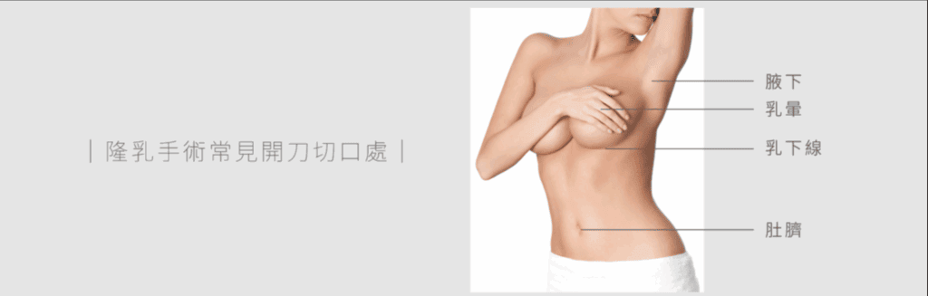 隆乳切口位置選擇