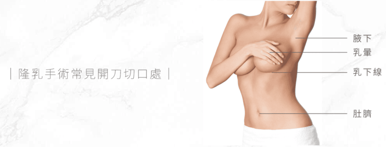 隆乳手術切口位置