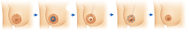 縮乳暈手術方式