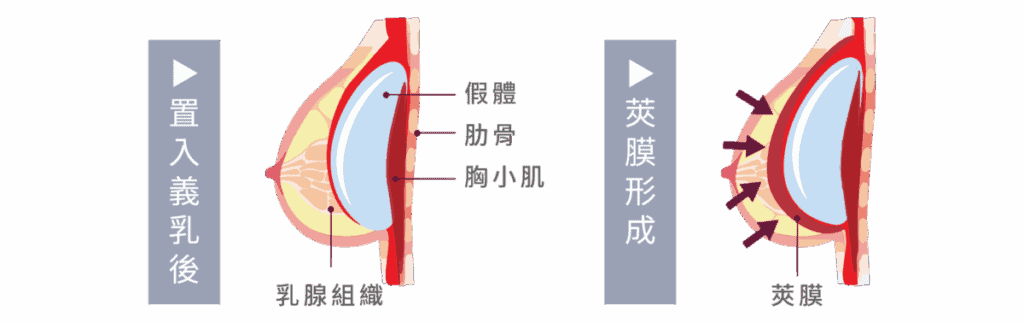何為莢膜？