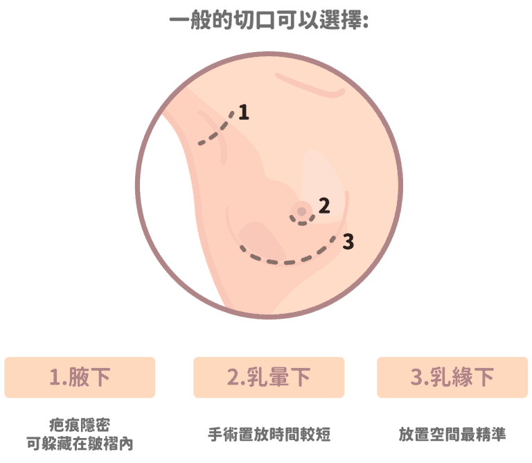 常見的隆乳切口位置（圖片來源：法喬醫美診所－隆乳手術介紹）
