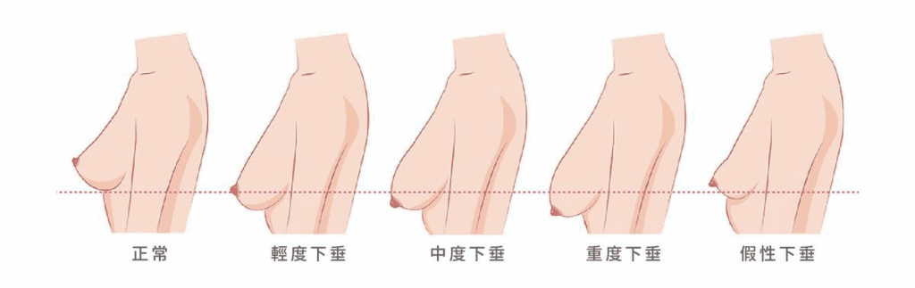 乳房下垂嚴重度參考示意圖（圖片來源：法喬醫美－提乳手術介紹）
